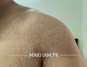 Skin Problem