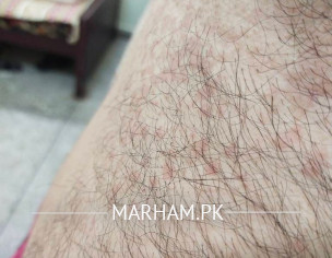 Skin Problem