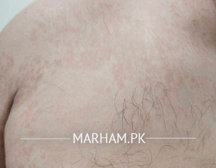 Skin Problem