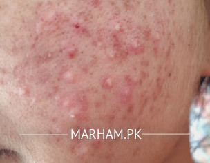 Ance And Acne Scars