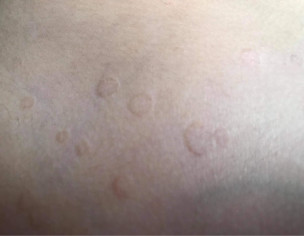 Skin Problem