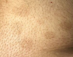 Skin Marks