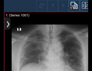 Post Covid19 COPD