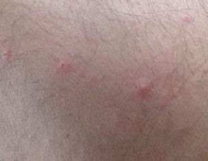 Allergy Blew Neck