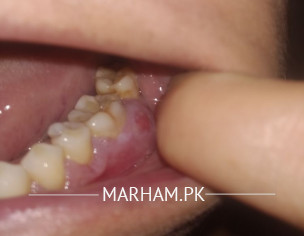 Dental Problem