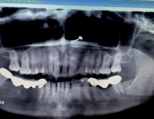 Dental Problem