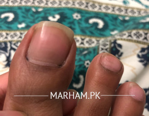 Nail-black Mark