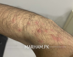 Skin Allergy