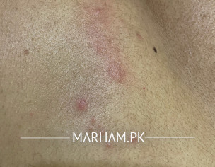 Skin Allergy