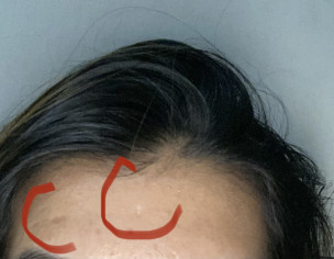 Acne Box Scars