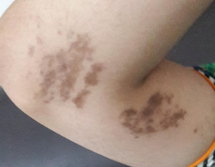 Skin Allergy