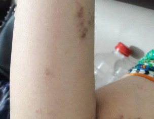 Skin Allergy