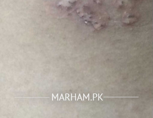 Rashes In Underarm 