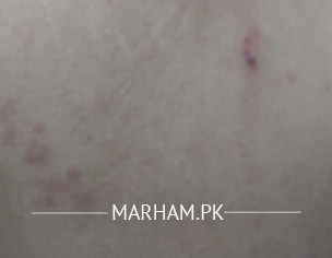 Rashes In Underarm 