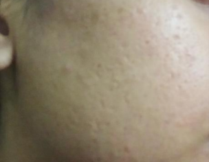Acne Scars