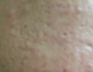 Acne Scars
