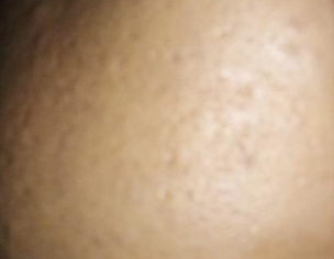 Acne Scars