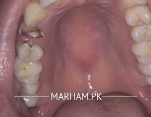 Teeth Cavity 
