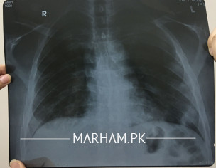 Damaged Lungs 