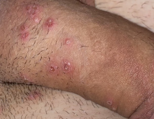 Pimples Or Infection ?