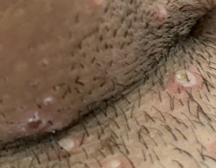 Pimples Or Infection ?