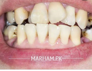 Tooth Problem
