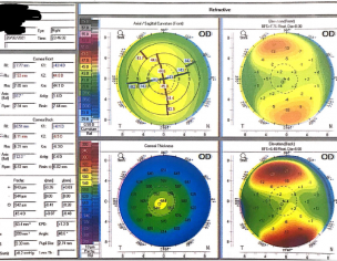 Eyesight, Lasik