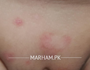Allergic Issue