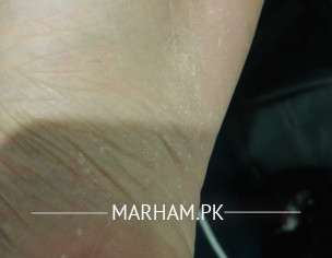 Skin Condition 