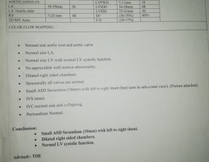 Small ASD Secundum