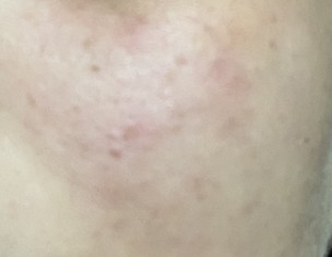 Skin Allergy