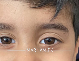 Droopy Eyelid
