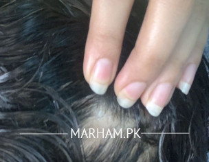Bald Patches 