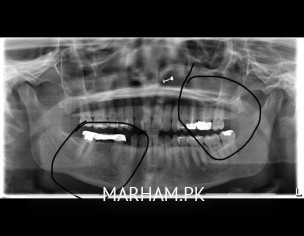 Dental Problems 
