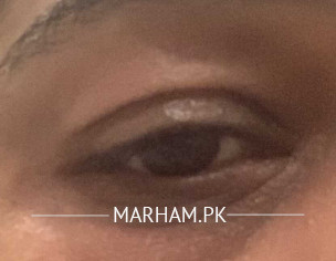 Eye Swelling