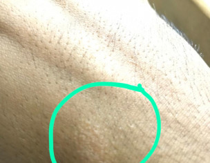 Skin Rashes On Hand Causing Irritation .