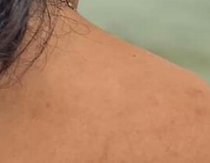 Back Acne Marks