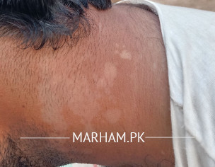Skin Problem