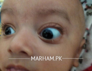 Eye Problem
