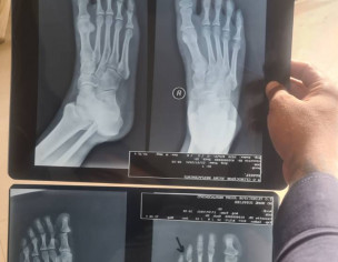 Bone Fracture