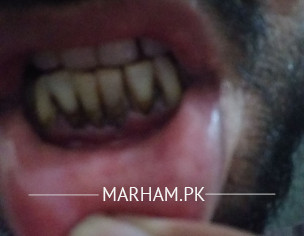 Teeth Problem