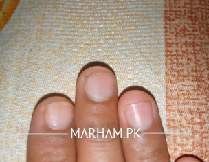 Nails Problm