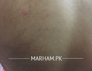 Rash Acne On Back