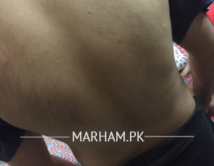 Rash Acne On Back