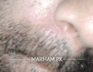 Skin Problem