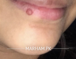 Pimple On Lip