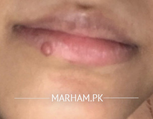 Pimple On Lip