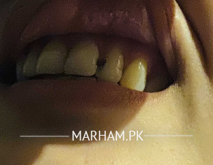 Teeth Problem