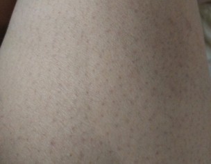 Black Patch