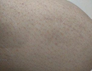 Black Patch